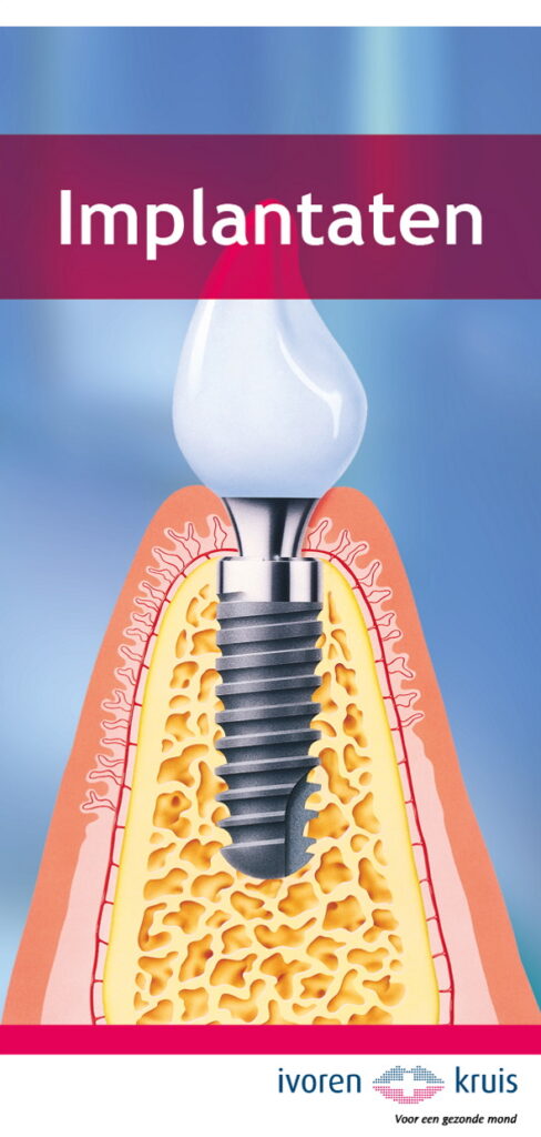 Ivoren-Kruis-Folder-Implantaten